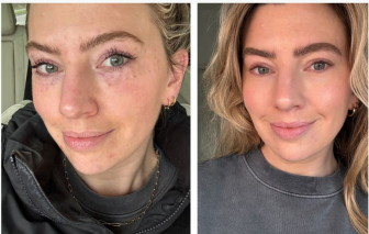 Cơn sốt trẻ hóa từ chiết xuất tinh dịch cá hồi 'làm mưa làm gió' thị trường thẩm mỹ