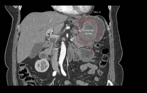 Bác sĩ FV dùng robot Da Vinci Xi bóc tách thành công khối u dạ dày to bằng nắm tay