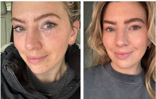 Cơn sốt trẻ hóa từ chiết xuất tinh dịch cá hồi 'làm mưa làm gió' thị trường thẩm mỹ