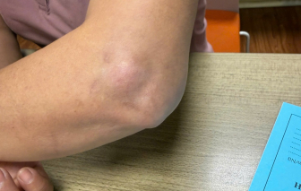 Cảnh giác mạo danh bác sĩ Bạch Mai tiêm thuốc khiến người bệnh bị biến chứng