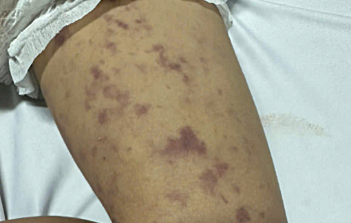 Một bệnh nhi 2 tuổi ở Đắk Lắk tử vong do mắc viêm não mô cầu