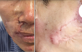 Một dấu hiệu nhỏ ở môi, lộ ung thư tái phát nhiều lần