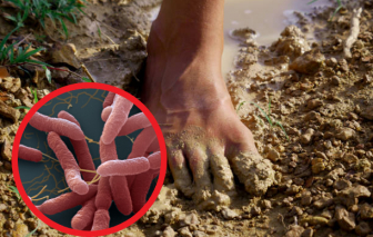 Gia Lai tập trung kiểm soát ca nhiễm vi khuẩn gây bệnh Whitmore đầu tiên