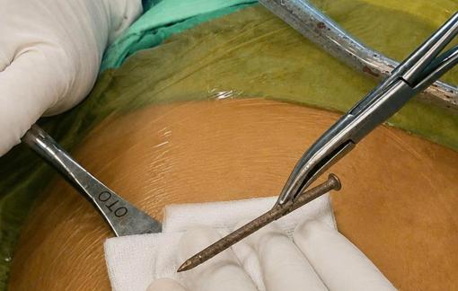 Bất cẩn khi dùng máy bắn đinh khiến dị vật xuyên thành bụng, suýt chết