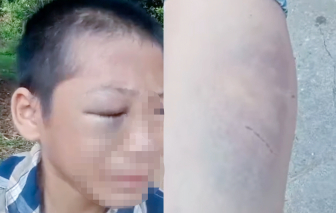 Công an vào cuộc xác minh clip bé trai bầm tím mắt nghi do bị bạo hành