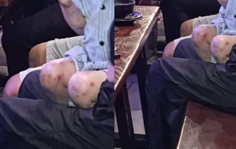 Bé gái chi chít vết bầm trên người trong quán bar ở Hà Nội là do viêm da cơ địa?