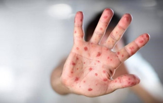 Làm sao biết trẻ bị tay chân miệng hay sốt phát ban?